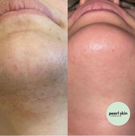 Pearl Skin Cosmetics Dresden - Laser Haarentfernung | HydraFacial | Microneedling